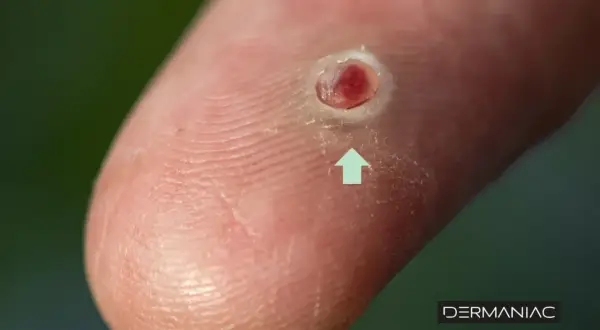 Primer plano de un dedo con una lesión cutánea roja y sangrante, indicando cuando un grano es peligroso.