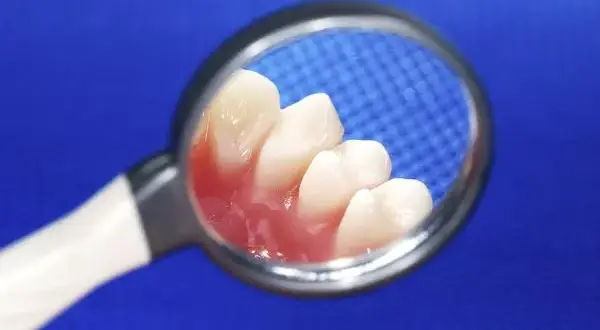 Co na bolące dziąsło od ósemki – skuteczne sposoby na ulgę i kiedy iść do dentysty