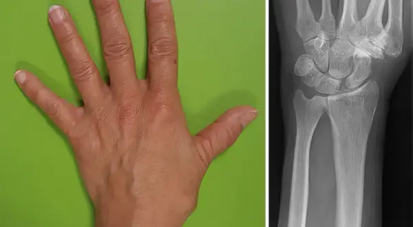 Hand und Röntgenbild des Handgelenks. Der **flexor carpi radialis** ist ein wichtiger Muskel für die Handbewegung.