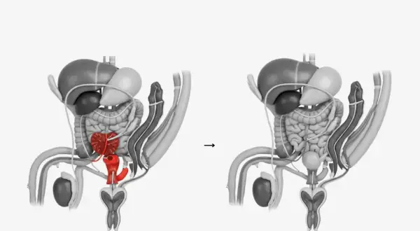 Anatomische Darstellung: Vorher (Prostata rot hervorgehoben) und nach der Prostataentfernung.