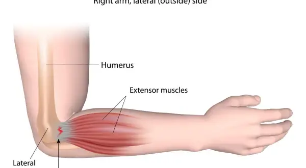 Illustration zeigt den rechten Arm bei Tennisarm. Schmerzen entstehen durch verletzte Sehnen am seitlichen Ellbogenknochen.