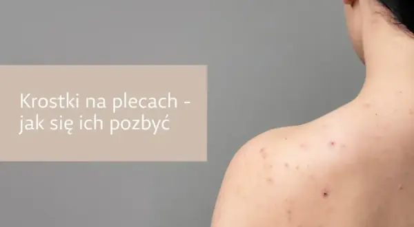 Ropny pryszcz: Szybkie i bezpieczne metody bez blizn!