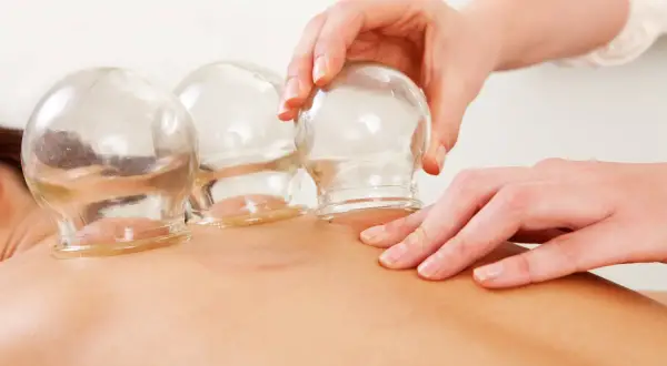 Coppette di vetro applicate sulla schiena, una tecnica che, come l'agopuntura, mira al benessere.