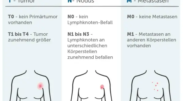 TNM-Klassifikation: Tumorgröße (T), Lymphknotenbefall (N) und Fernmetastasen (M) zur Beurteilung von malignen Tumoren.