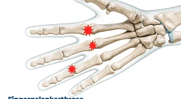 Illustration der Knochen der Hand, die Schmerzen durch Arthrose in den Fingergelenken zeigt.