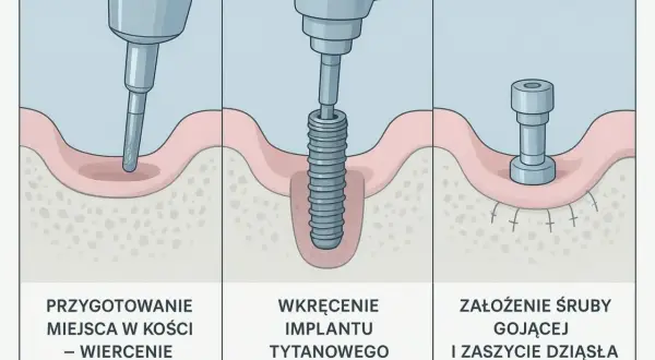 Wizualizacja etapy implantacji zęba: wiercenie, wkręcanie implantu tytanowego, założenie śruby gojącej. Czy implant zęba boli? Proces jest bezbolesny.