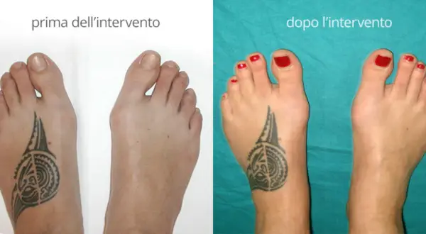 Confronto alluce valgo prima e dopo intervento. Il piede sinistro mostra un evidente alluce valgo, il destro è corretto.