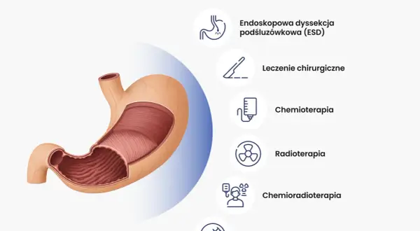 Nowoczesne leczenie raka żołądka obejmuje ESD, chirurgię, chemioterapię, radioterapię, chemioradioterapię i immunoterapię.
