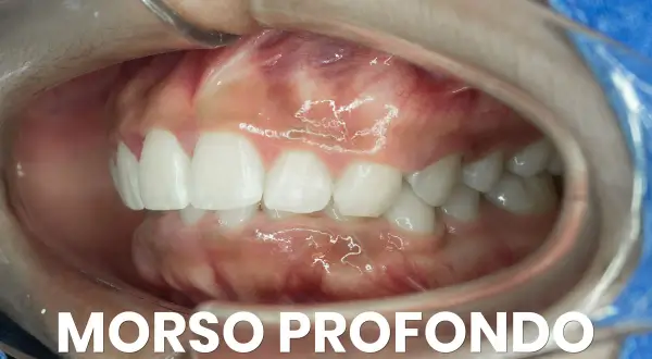 Primo piano della bocca con morso profondo, evidenziato per chirurgia maxillo-facciale.