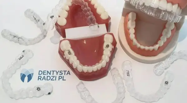 Modele szczęk pokazują, jak zakładać gumki na aparat ortodontyczny. Przezroczyste nakładki są ułożone wokół modeli.