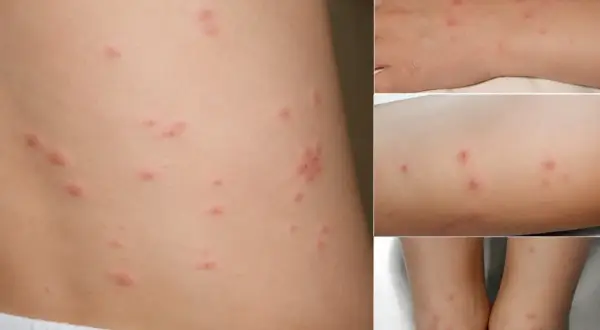 Skóra z licznymi czerwonymi, swędzącymi zmianami, które mogą być objawem ugryzienia roztoczy. Widoczne na brzuchu, ręce, nodze i stopach.