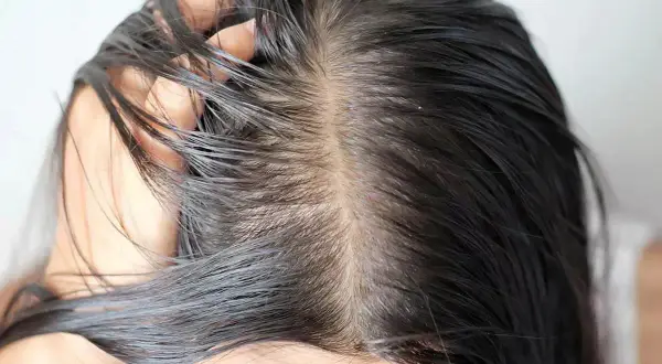 Primer plano del cuero cabelludo de una mujer con pelo graso, mostrando la separación del cabello y el brillo aceitoso.