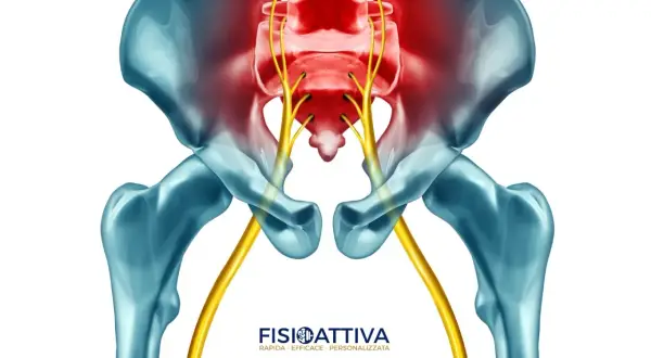 Dolore al nervo sciatico che causa scosse gamba sinistra. Anatomia del bacino e nervi evidenziati in rosso.