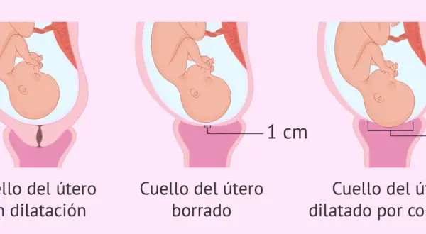Ilustración muestra la dilatación del cuello uterino durante el parto: sin dilatación, borrado y dilatado por completo (10 cm).