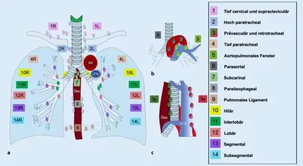 Schema der Lymphknotenstationen im Thorax. Station 10 zeigt die **hilus lymphknoten** im Lungenhilus.