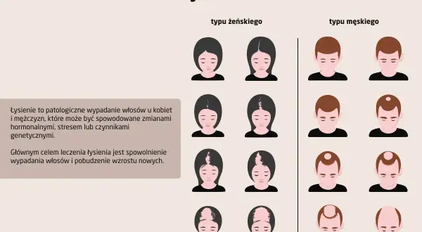 Ilustracja pokazuje różne rodzaje łysienia u kobiet i mężczyzn, od początkowych etapów po zaawansowane.