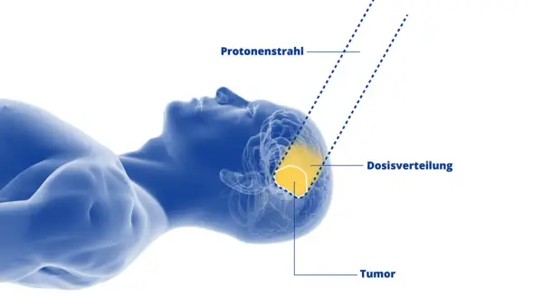 Protonenstrahltherapie zur Behandlung eines Hirntumors. Die Dosisverteilung zeigt, wie der Protonenstrahl den Tumor präzise trifft. Dies kann die Lebenserwartung bei Sarkomen verbessern.