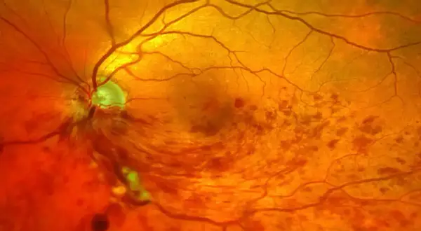 Nahaufnahme des Augenhintergrunds mit Anzeichen eines Schlaganfalls im Auge. Blutgefäße sind sichtbar, einige Bereiche sind verfärbt.