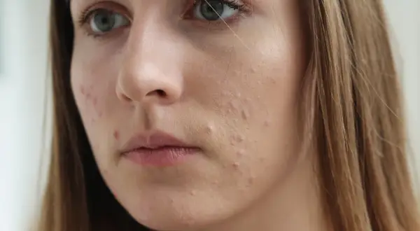 Młoda kobieta z niedoskonałościami na twarzy, być może stosuje sudocrem na twarz, by je zredukować.