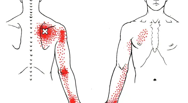 Dolor serrato posterior superior: Alivio y prevención efectiva