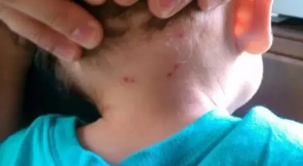 Cómo evitar las picaduras de pulgas en humanos y sus efectos dañinos