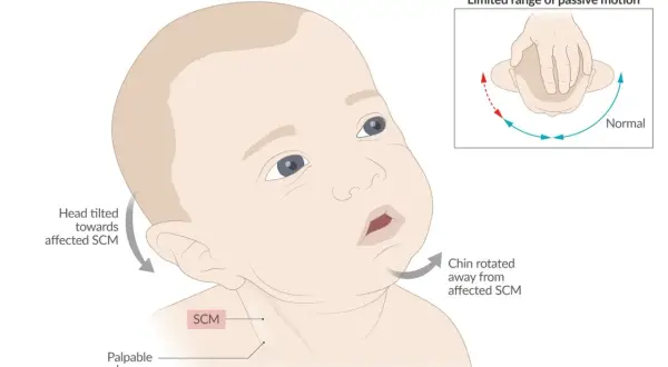 Baby mit angeborenem Schiefhals (torticollis spasticus). Kopf zur betroffenen SCM geneigt, Kinn weggedreht. Eingeschränkte Beweglichkeit.