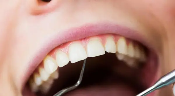 Usta z widocznym małym ubytkiem w zębie, badane narzędziem dentystycznym.