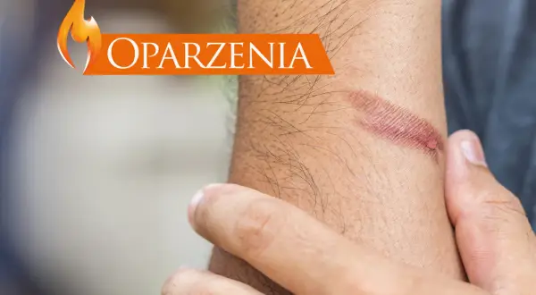 Oparzenia na przedramieniu. Zobacz, co na oparzenia pomoże.