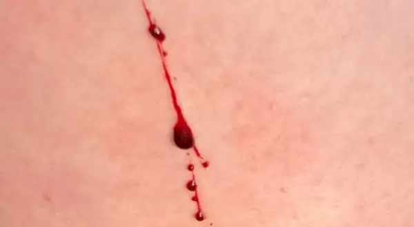 Rote Kratzer auf der Haut ohne Grund, mit Blutstropfen, die langsam herunterlaufen.