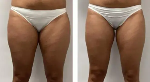Endermologia: Kiedy efekty? Po 3 sesjach już widać! Pełna przemiana