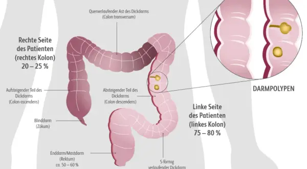 Illustration des Dickdarms mit Markierung des Rektums (ca. 50-60%). Darmpolypen können frühe rektumkarzinom symptome sein.