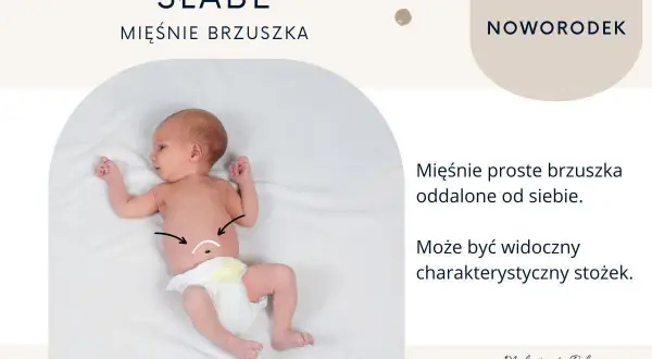 Noworodek z widocznym rozejściem mięśni brzucha, zaznaczonym na brzuszku.