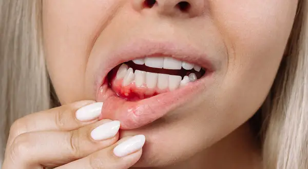 Una persona se toca la encía inflamada y con sangrado dental, mostrando los dientes blancos.