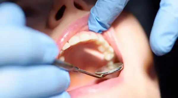 Dentysta bada zęby, szukając oznak próchnicy wtórnej.