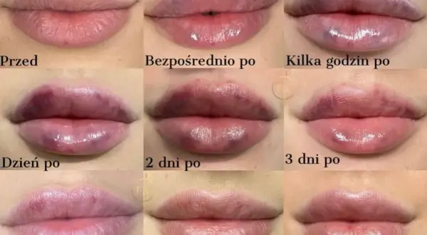 Kwas hialuronowy w ustach: Ile się utrzymuje i jak przedłużyć efekt?