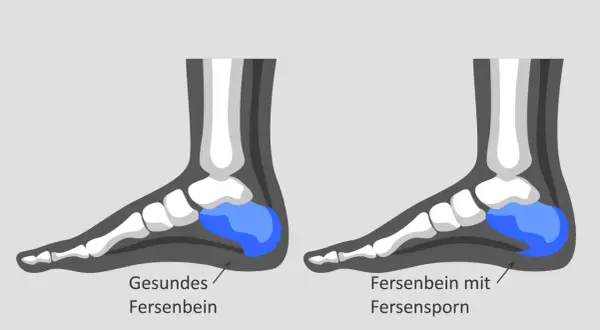 Vergleich von gesundem Fersenbein und Fersenbein mit oberem Fersensporn. Der Fersensporn ist als knöcherner Auswuchs am Fersenbein dargestellt.