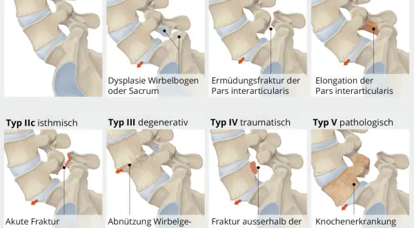 Abbildungen zeigen verschiedene Typen von Gleitwirbel LWS, von normal bis zu Frakturen und Erkrankungen.
