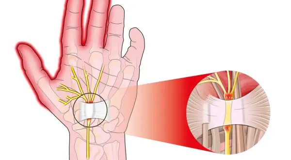 Illustrazione anatomica che mostra la compressione di un nervo nel polso, causa di dolore alla mano.