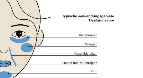 Schema zeigt typische Anwendungsgebiete für Hyaluron in der Haut: Tränenrinnen, Wangen, Nasolabialfalten, Lippenregion und Kinn.
