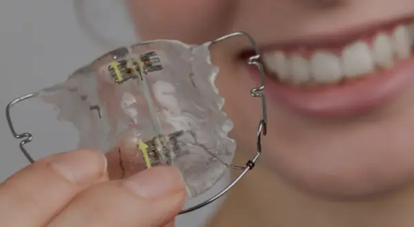 Dita tengono un apparecchio mobile notturno trasparente con fili metallici e viti. Sullo sfondo, un sorriso bianco e luminoso.