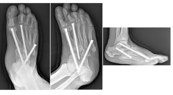 Radiografie di un piede Charcot con viti metalliche che stabilizzano le ossa fratturate.