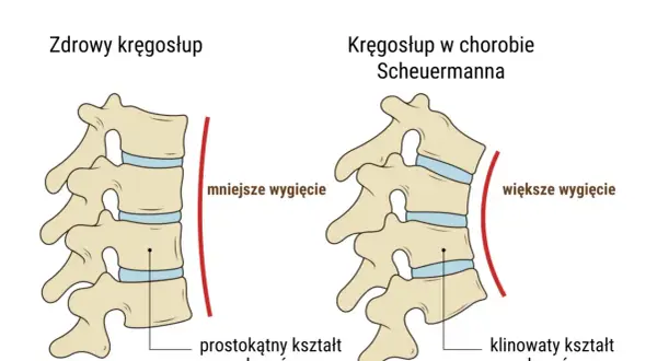 Ilustracja porównująca zdrowy kręgosłup z kręgosłupem w chorobie Scheuermanna.