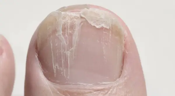Nahaufnahme eines Zehennagels mit querrillen und abgebrochenen Stellen.