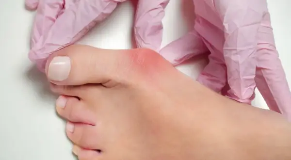 Mani con guanti rosa esaminano un alluce infiammato, evidenziando la zona rossa. Si cercano rimedi per l'alluce infiammato.