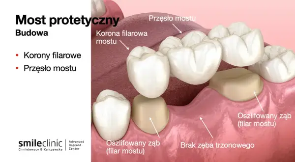 Most protetyczny z przęsłem i koronami filarowymi, uzupełniający brak 2 zębów obok siebie.