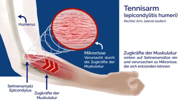Illustration zeigt den rechten Ellenbogen bei einem Tennisarm. Zugkräfte der Muskulatur verursachen Mikrorisse am Sehnenansatz.
