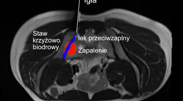 Leczenie zapalenia stawu krzyżowo-biodrowego: od leków po terapie