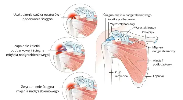 Ilustracja anatomiczna barku z zaznaczonymi uszkodzeniami stożka rotatorów: naderwanie ścięgna, zapalenie kaletki i zwyrodnienie.