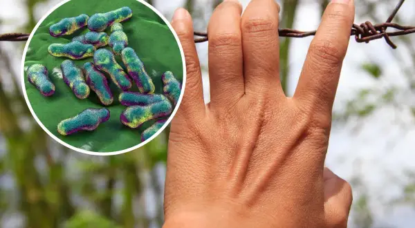 Dłoń dotykająca drutu kolczastego, obok powiększenie bakterii Clostridium tetani. Wczesne tężec objawy mogą być subtelne, ale choroba jest groźna.