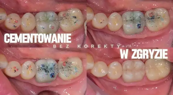 Jak stosować cement NoMIX, aby uniknąć nieprzyjemnych sytuacji z koronami dentystycznymi